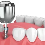Восстанавливает качества улыбки: особенности успешного проведения двухэтапной имплантации зубов