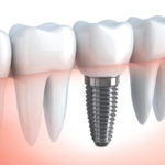Що таке протезування та імплантація зубів